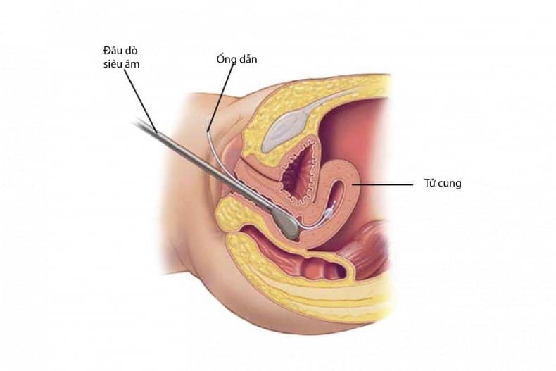 danh-gia-vo-sinh-hiem-muon-nu-sieu-am-bom-nuoc-buong-tu-cu