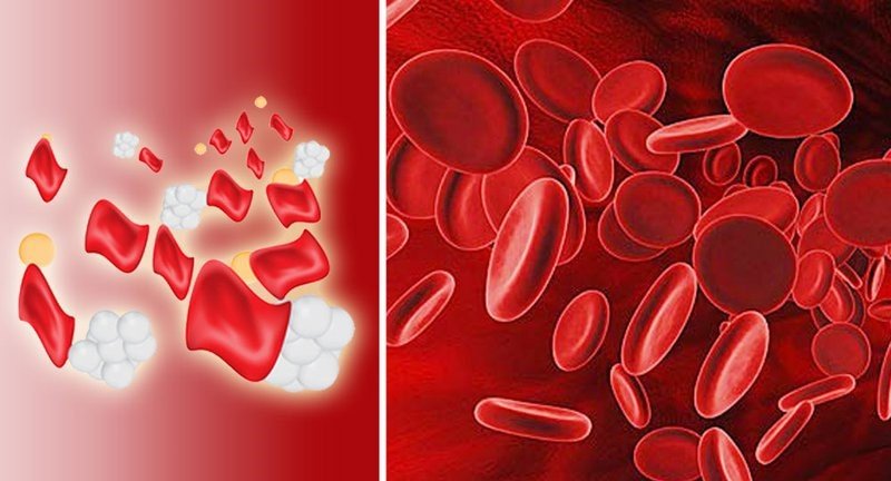 bệnh thalassemia có nguy hiểm không?