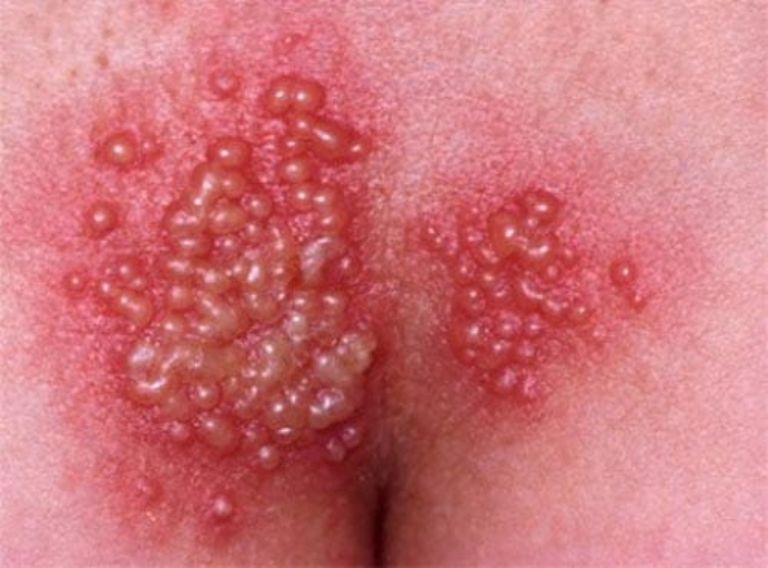 Những biến chứng do mụn cóc HPV gây ra