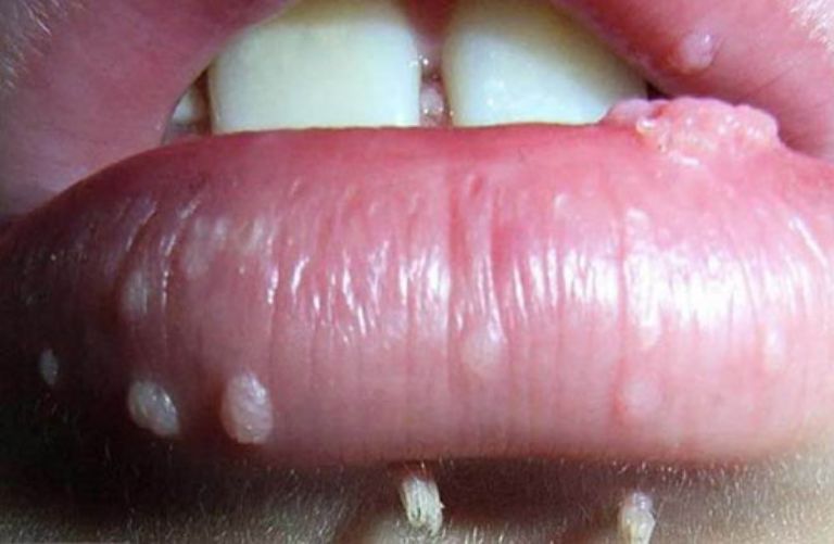 Mụn cóc HPV mọc ở miệng 