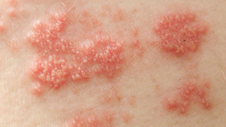 Virus HPV Gây Mụn Cóc Ở Bộ Phận Nào?