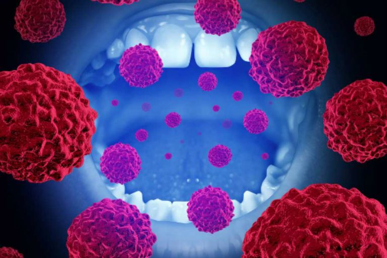Top 6 Bệnh Lý Ở Miệng, Lưỡi Do Virus HPV Gây Ra