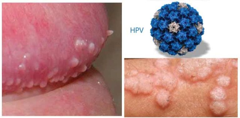 Virus HPV Ở Nam Giới Gây Ra Bệnh Gì? Dấu Hiệu, Nguyên Nhân