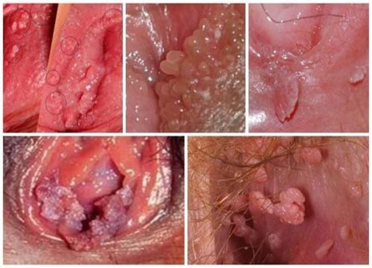 Dấu hiệu nhiễm HPV sinh dục