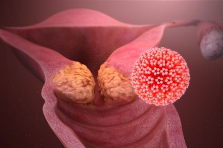 Bị HPV Ở Bộ Phận Sinh Dục: Dấu hiệu, Cách Chữa, Điều Cần Biết