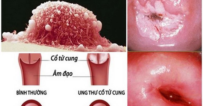 Ung Thư Cổ Tử Cung Và Virus HPV: Quá Trình Gây Bệnh, Lây Lan