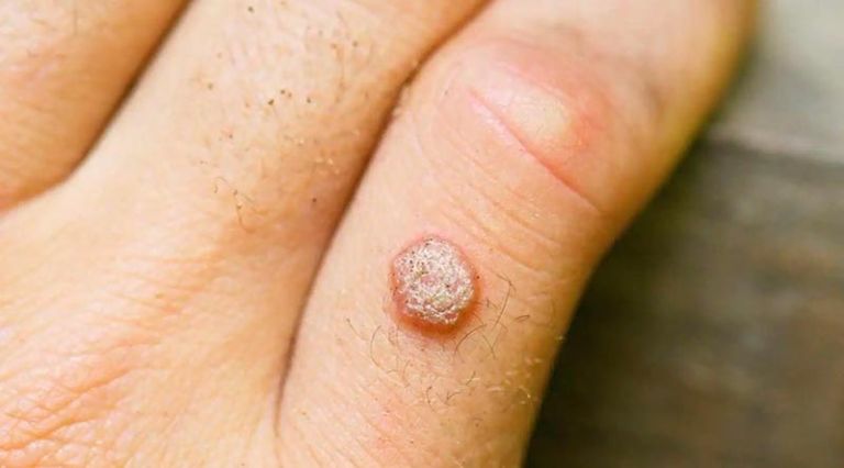 Mụn Cóc (Mụn Cơm) Là Gì? Có Mấy Loại, Dấu Hiệu, Nguyên Nhân