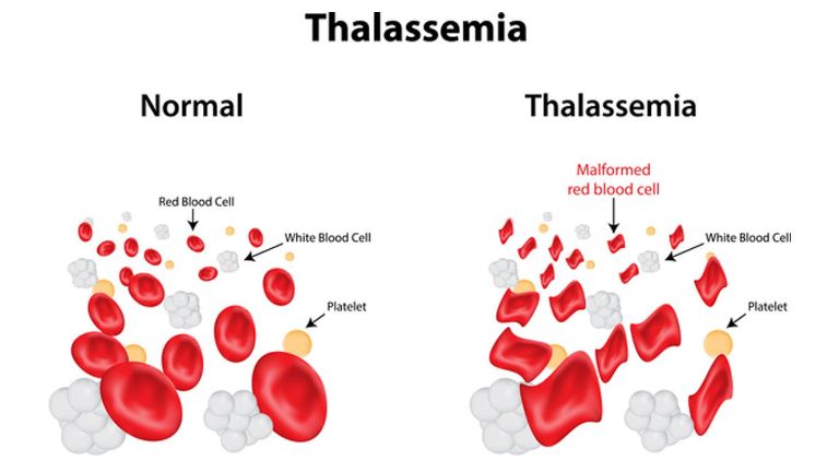xét nghiệm gen thalassemia