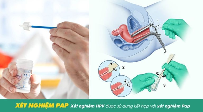 Có nên xét nghiệm đồng thời cả PAP và HPV không?