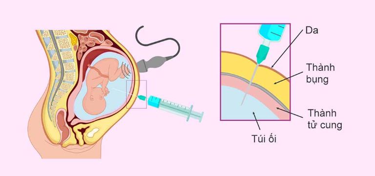 Quá Trình Chọc Ối Diễn Ra Thế Nào? Tư Vấn Từ A-Z