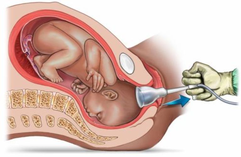 Chọc Ối Xong Kiêng Những Gì? Ăn gì? Lưu Ý Sau Khi Chọc Ối