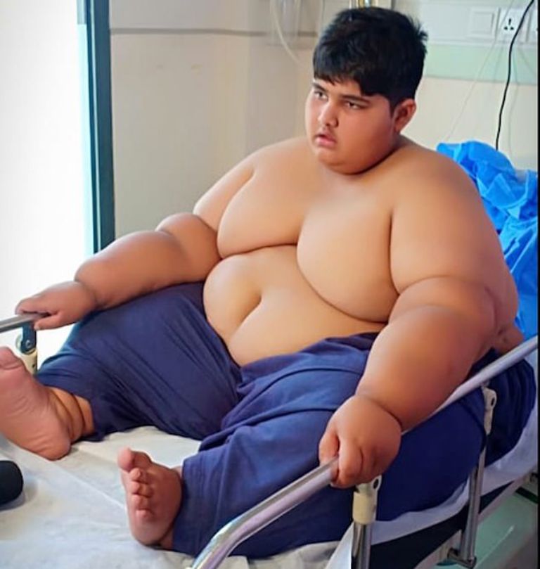 Người mắc hội chứng Prader Willi có dấu hiệu béo phì do ăn nhiều 