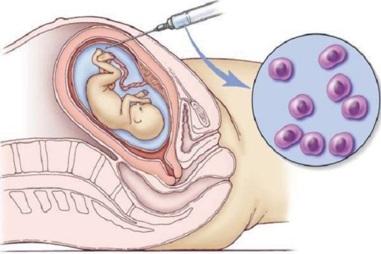 Chọc Ối Sàng Lọc Trước Sinh Khi Nào? Thai Phụ Nào Cần Làm?