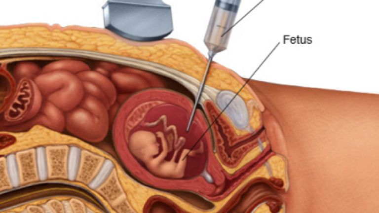 Chọc Ối Có Phải Nằm Viện Không? Bao Lâu Thì Khỏi?