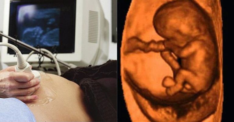 Sàng Lọc Dị Tật Thai Nhi Ở Tuần Thứ Bao Nhiêu? Tư vấn cả thai kỳ