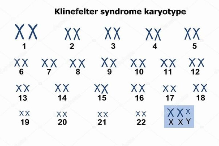  Hội chứng Klinefelter