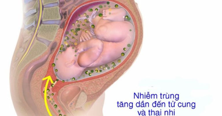 Thai phụ cần nắm rõ dấu hiệu cho thấy nguy cơ biến chứng sau chọc ối