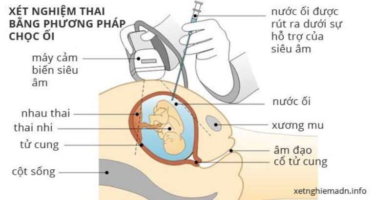 Tổng Hợp 10 Kinh nghiệm Đi Chọc Ối Được Các Mẹ Bầu Chia Sẻ
