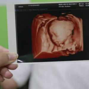 Mang thai lần đầu bị dị tật